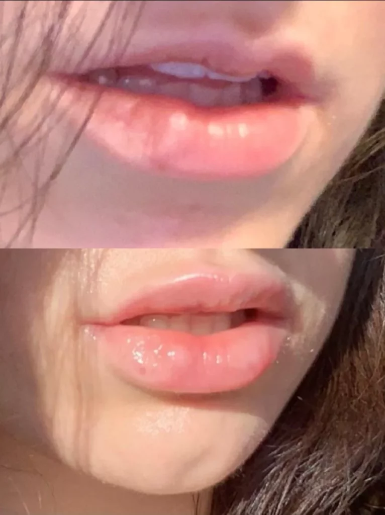 lip-fillers before n after